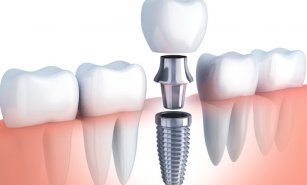 Dental Implant Tedavisi Hakkında Bilgi