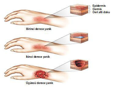Güneş yanığı dereceleri