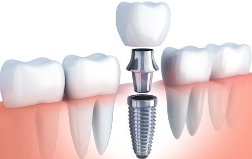 Dental implant